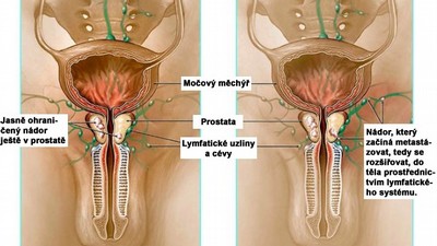 Nákres rakovinného nádoru prostaty
