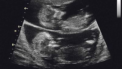 Dvojče A, oddělené přepážkou (amniální - plodovou - membránou) od dvojčete B. Dvojče B je uloženo ve vlastním plodovém obalu - jedná se o těhotenství dvouvaječné, se dvěma amniálními dutinami. 